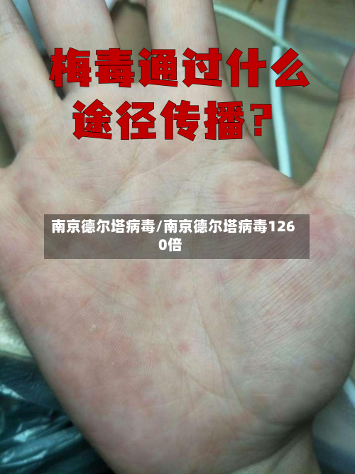 南京德尔塔病毒/南京德尔塔病毒1260倍