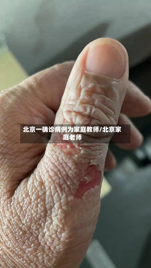 北京一确诊病例为家庭教师/北京家庭老师-第3张图片