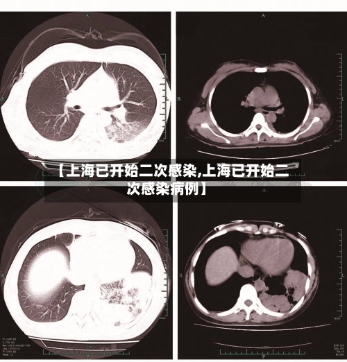 【上海已开始二次感染,上海已开始二次感染病例】-第3张图片