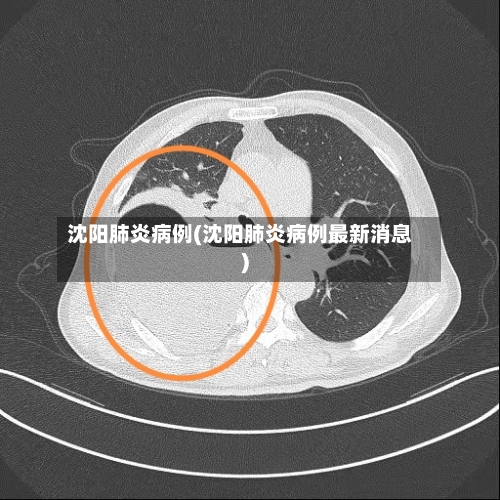 沈阳肺炎病例(沈阳肺炎病例最新消息)