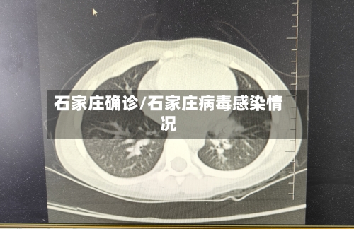 石家庄确诊/石家庄病毒感染情况